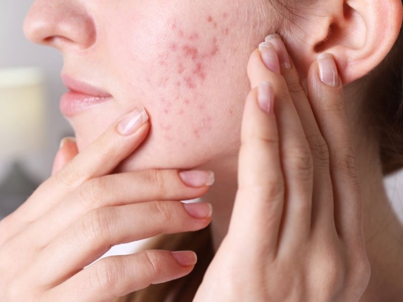 Acne Treatment