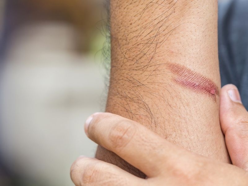 Scar repair
